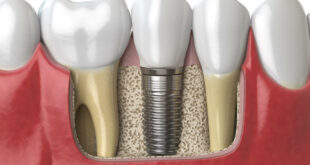 Dental Implants Modern Solutions for Missing Teeth