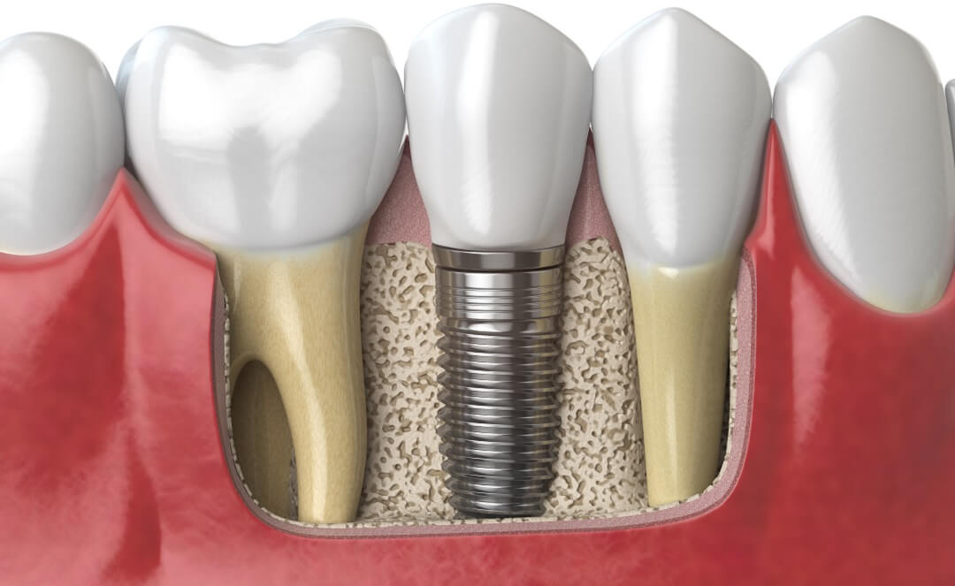 Dental Implants Modern Solutions for Missing Teeth